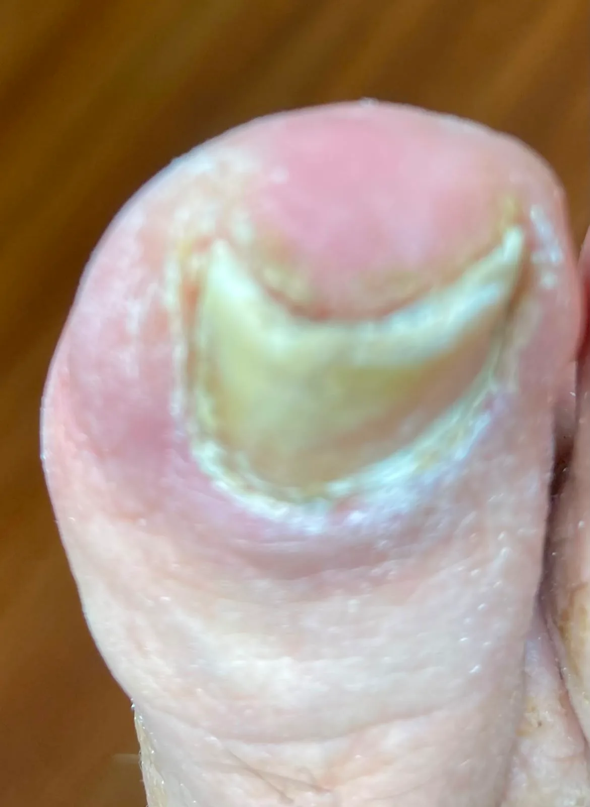 Großzehennagel mit Nagelpilz vor dem Abschleifen