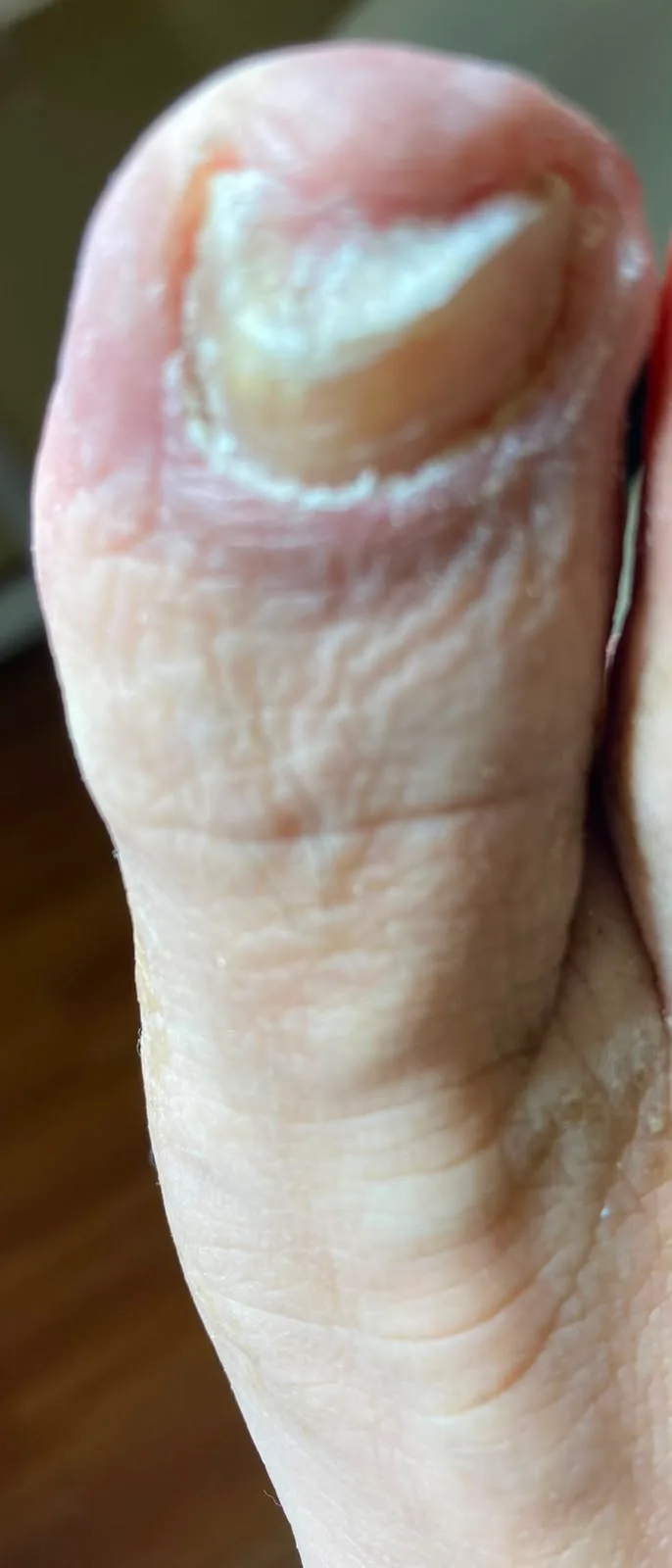 Derselbe Zeh nach dem Entfernen der pilzhaltigen Nagelsubstanz