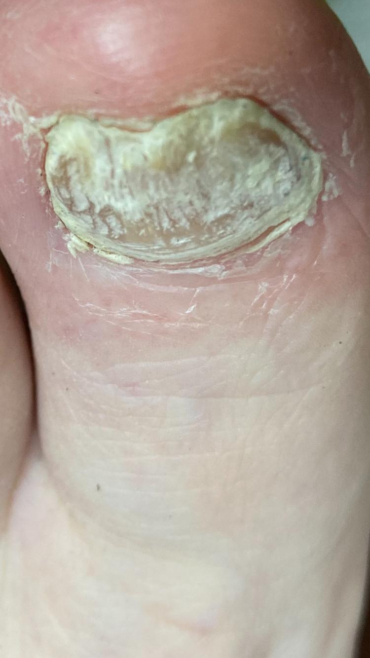 Nagelpilz am großen Zeh vor der Behandlung