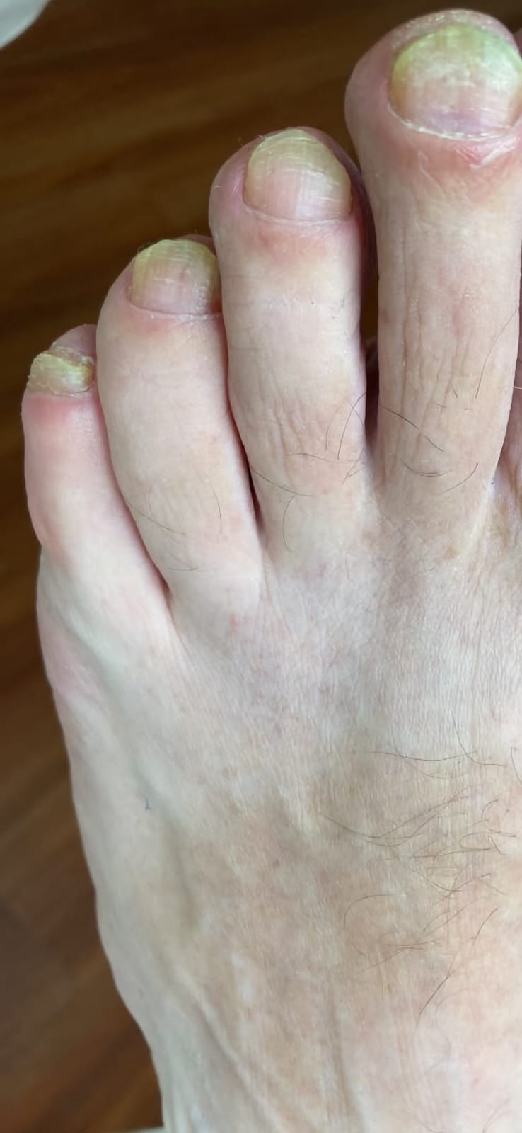 Zehennägel mit Nagelpilz vor der Behandlung